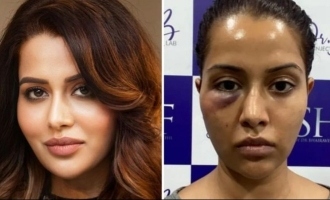 Raiza Wilson shares photo about her face conditon now - What will be her decision?