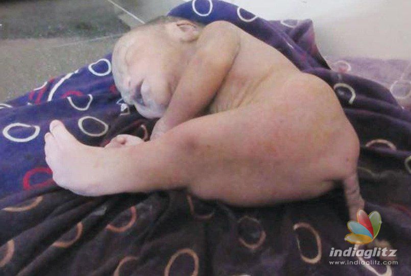 Baby born with tail, fused legs in India