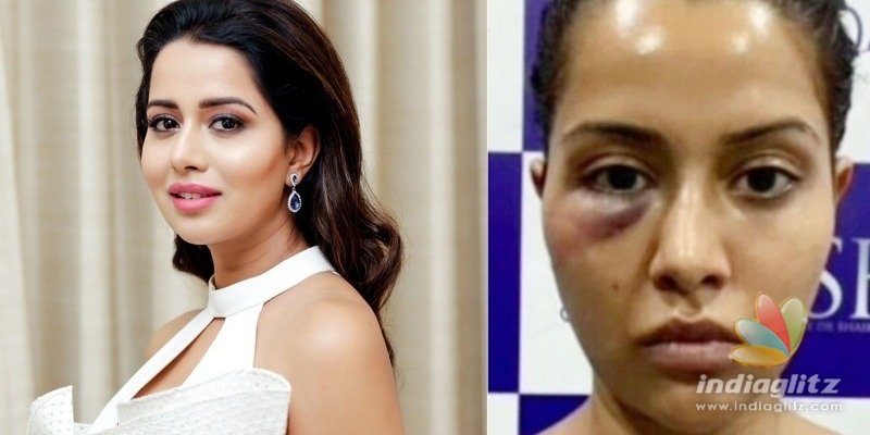 Raiza Wilsons facial treatment goes wrong, blames dermatologist